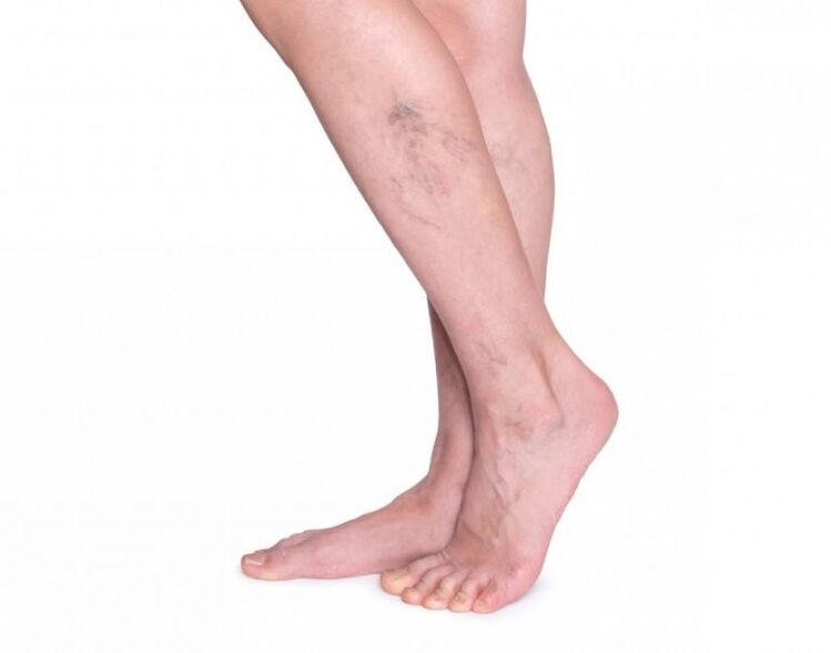 Varicose veins before treatment VariForce