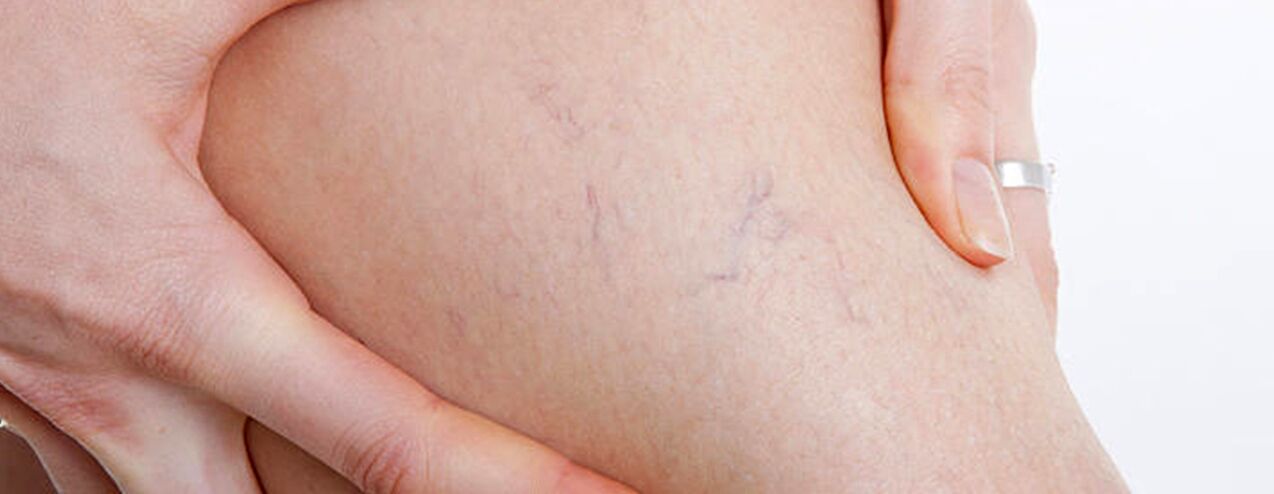 how do varicose veins develop