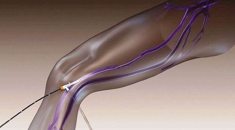 Radiofrequency obliteration – a method of treating varicose veins